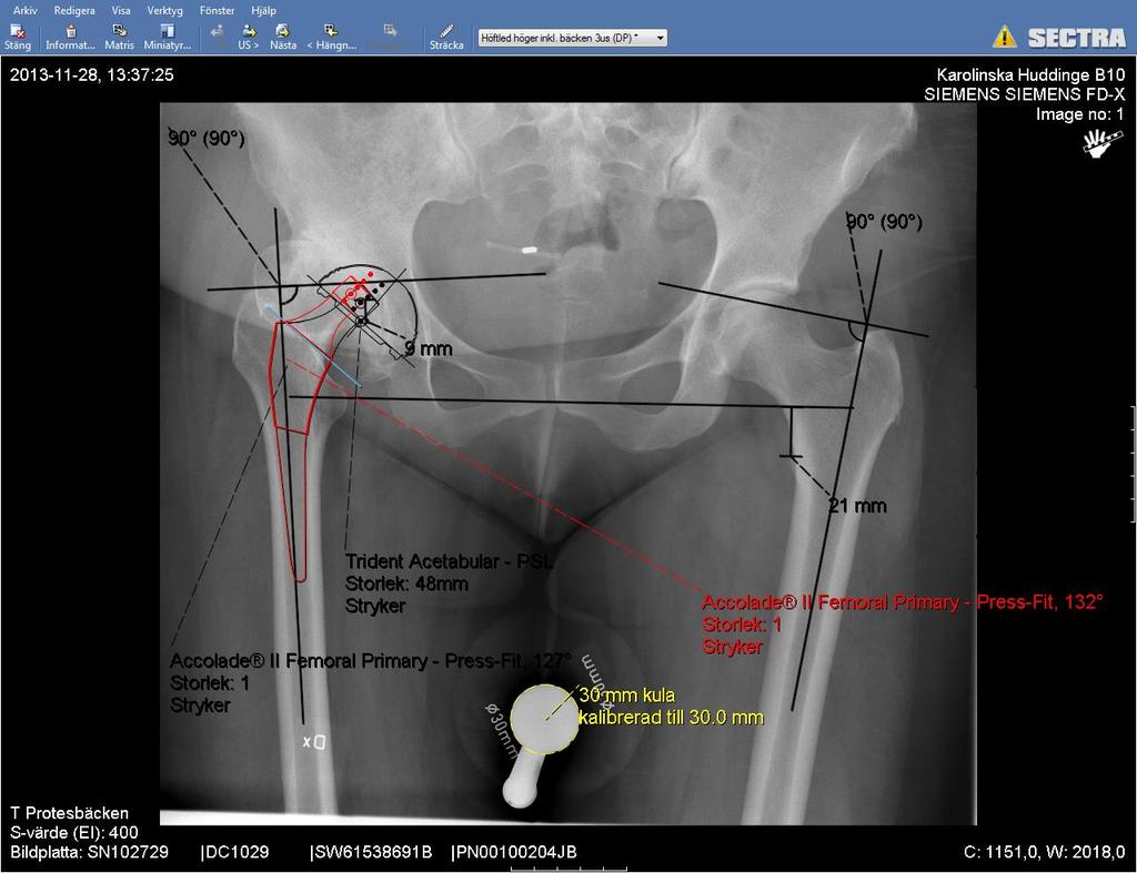 Preop