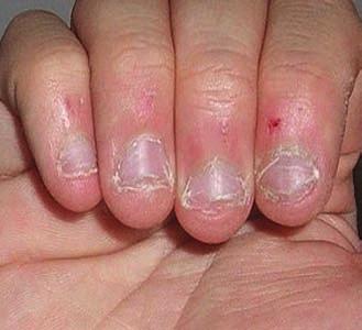 Nageltillstånd och besvär Nagelbitning Onychophagy Deformerar nagelplattan och nagelbanden.