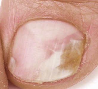 Nageltillstånd och besvär Svamp Onychomykosis Infektionen börjar i hörnen på nageln och kryper inåt.