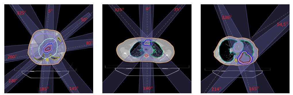 A B C Figure 5. Tumor location and beam angles for three thoracic cases. A: 1, central located tumor. B: 2, ventral located tumor. C: 8, lateral and dorsal located tumor. Table 3.