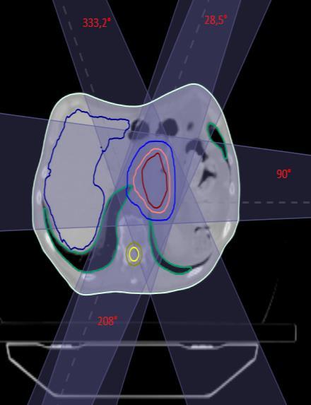 The chosen beam angles were based on the treatment planners own experience to obtain a clinical accepted treatment plan.