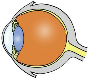 Vad är Glaukom? Glaukom är en ögonsjukdom som drabbar synnerven. Synnerven förmedlar synintryck till hjärnan och en skada leder till att synfältet gradvis krymper med fläckvis synbortfall.