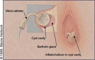 Word-kateter vid bartolinit Bedöva med EMLA/Xylocaingel el spray och Xylocain-Adrenalin
