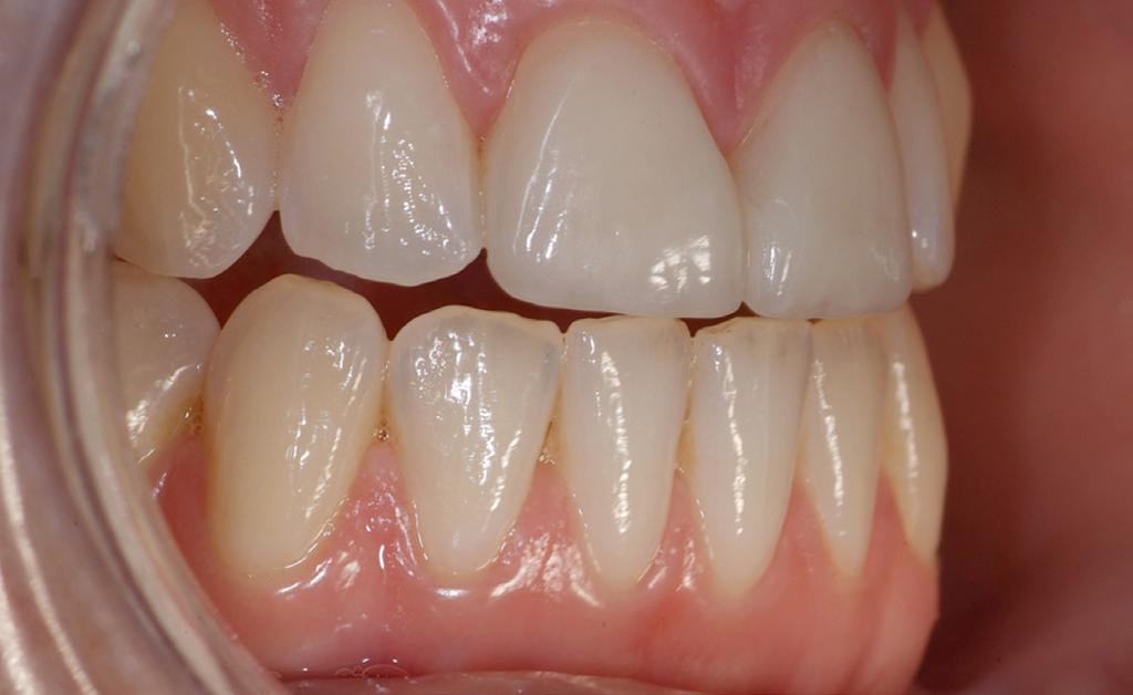 max Ceram Lava Ceram 50-120 < 1 Adhesivt cementerade skalfasader M** Glaskeramer: Leucitbaserade Litiumdisilikatbaserade IPS Empress CAD IPS Empress Esthetic Hass Rosetta BM IPS e.max CAD IPS e.