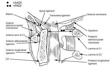 spondyloepifyseal dysplasi, neurofibromatos, chondodysplasi, Kniest sndr, Down s syndrom