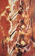 Jónsson H Jr. Bring G, Rauschning W, Sahlstedt B. Hidden cevical spine injuries in traffic accident victims with skull fractures.