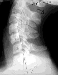 Whiplashrelaterade besvär. Kriterier för bedömning av orsakssamband. NRH-s-seminarium 181101 9(24) Bild 19 1 b. Kan skadorna diagnosticeras?