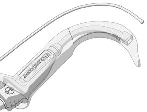 TIPS ANVÄNDNING AV GLIDESCOPE-SYSTEMET GlideScope videolaryngoskop är konstruerat för att föras ner längs tungans mittlinje till epiglottis.