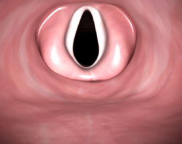 Bra vy av glottis 3. Titta i munnen:styr försiktigt in den distala spetsen av tuben i position nära laryngoskopspetsen. 4.