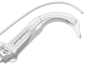 TIPS FÖR ANVÄNDNING AV GLIDESCOPE AVL-SYSTEMET GlideScope videolaryngoskop är konstruerat för att föras ner längs tungans mittlinje till epiglottis.