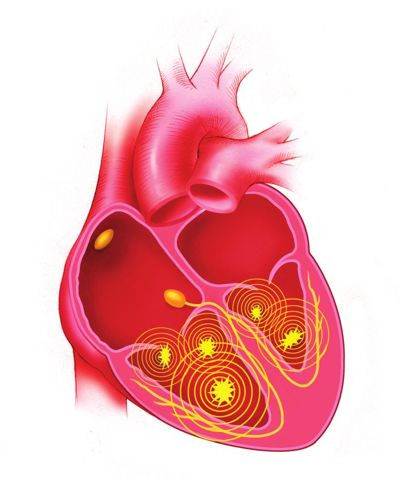 Kammarflimmer En annan typ av arytmi är kammarflimmer. En väldigt snabb, oregelbunden hjärtrytm där de elektriska impulserna kommer från olika delar av kamrarna (figur 5).