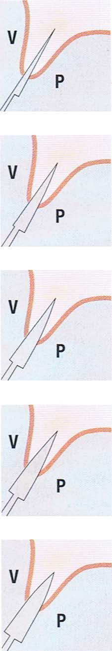 Måtten täcker de flesta implantatsystem.