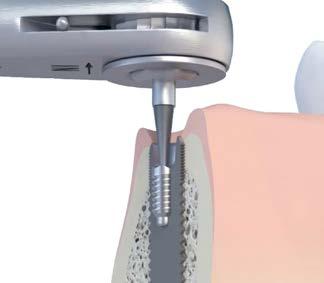 frakturerade skruvar inuti implantatet.
