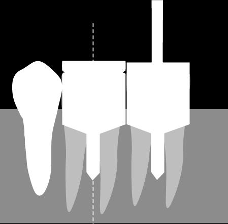 implantatguide Passar alla implantatsystem 4st (Ej