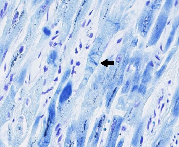 Figur 3. Hjärta med hjärtinfarkt på glas 1.1.1, kontraktionsband färgades stark blå och indikeras av svarta pilar medan cellkärnor färgades i violett. Förstorning vid 170x.