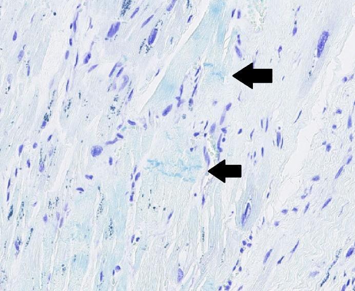 Hjärta med hjärtinfarkt på glas 2, kontraktionsband färgades svag blå och indikeras av svarta pilar medan cellkärnor färgades in i violett. Förstorning vid 139x.