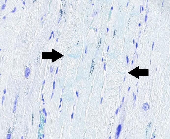 1 hade något mer blå infärgad erytrocyter än vävnaden på objektglas 2.1.2. Figur 6. Hjärta med hjärtinfarkt på glas 2.1.1, kontraktionsband färgades blå och indikeras av svarta pilar medan cellkärnor färgades i violett.