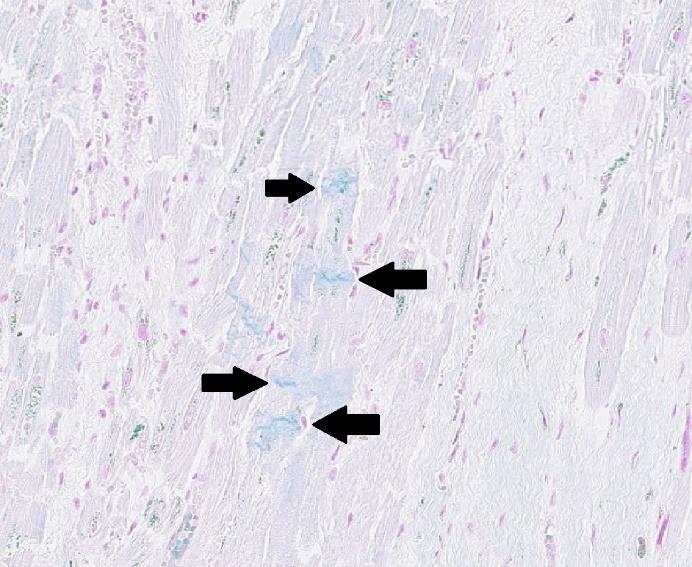 Figur 11. Hjärta med hjärtinfarkt på glas 3.3.1, kontraktionsband färgades blå och indikeras av svarta pilar medan cellkärnor färgades röda. Förstorning vid 124x. Figur 12.