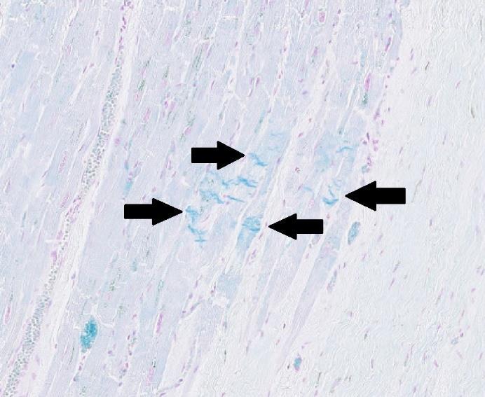 Figur 13. Hjärta med hjärtinfarkt på glas 3.5.1, kontraktionsband färgades blå och indikeras av svarta pilar medan cellkärnor färgades röda. Förstorning vid 101x. Figur 14.