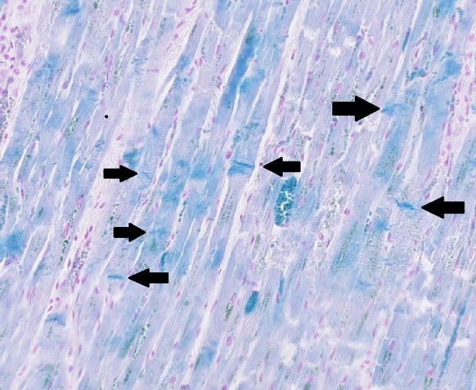 Figur 15. Hjärta med hjärtinfarkt på glas 3.6.2, kontraktionsband färgades blå och indikeras av svarta pilar medan cellkärnor färgades röda. Förstorning vid 100x.