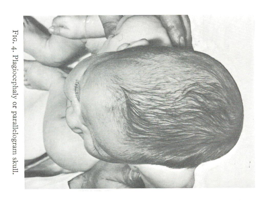 Plagiocephali Okoordinerade ögonrörelser There is an unexplained tendency for