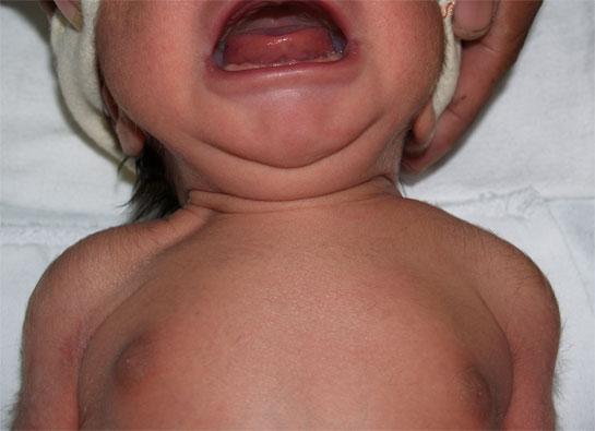 (Vulliamy, The Newborn Child, 1972) Subkonjunktival blödning Skelning Normalt