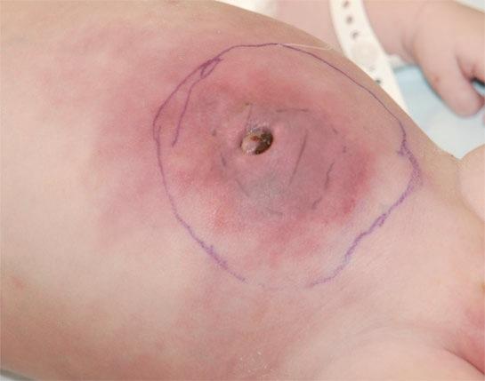 normal inflammatorisk