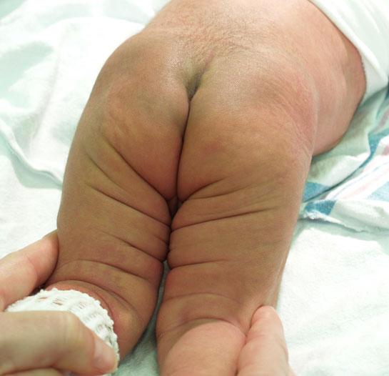 Navel - skötsel och infektioner Höftledslux -