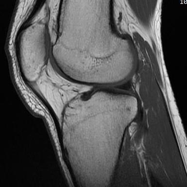 Exempel: Knän Man använder NMR undersökning, inte röntgenbilder. Undersökning av distal femur, och dens tillväxtzon. Metoder varierar.