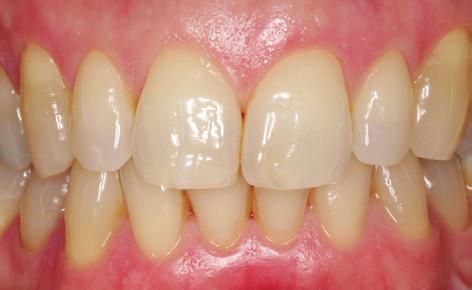 Så utvecklas parodontal sjukdom Friskt tandkött Ett friskt tandkött är ljust rosa och sluter stramt runt varje tand. Det blöder inte vid tandborstning eller vid rengöring mellan tänderna.