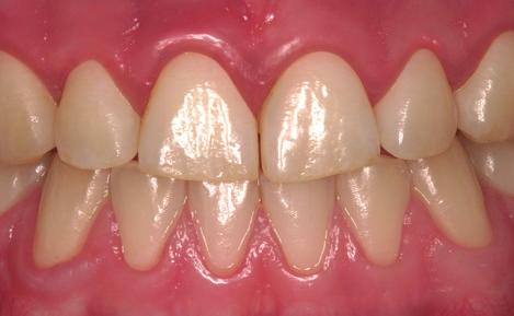 Gingivit = tandköttsinflammation Parodontit = tandlossning Parodontal sjukdom = sjukdom i tandens stödjevävnad Gingivit Ett inflammerat tandkött är rödare till färgen, blankt, svullet och ibland ömt.