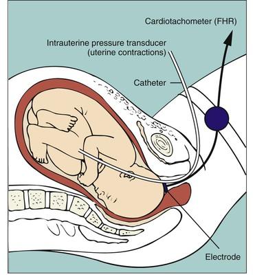 Intrauterin värkmätare Registrerar även intensitet och basaltonus Hinnor brustna eller amniotomi Cervix bör vara öppen 1-2 cm Färdigpackat kateterset Brukar föra upp katetern längs barnets rygg Ska