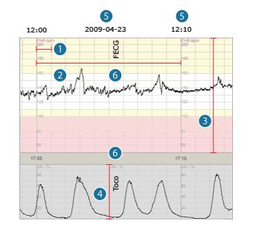 CTG 1.Hastighet, 1 cm/minut 2.Registreringen, minst 20 minuter 3.