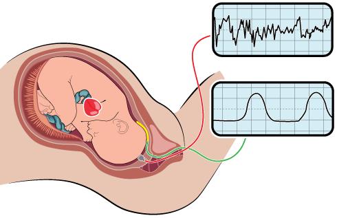 Skalpelektrod Fästs på ffd (även säte ok) OBS ej genitalia eller ansiktet EKG signal direkt från barnet (R-R intervallet) Bra att sätta skalp vid dålig kontakt ej godkänd/osäker variabilitet