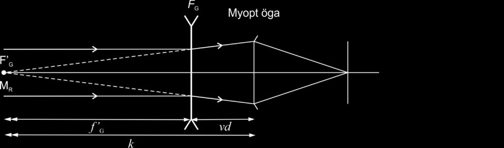 Optik 1 54 Föreläsning 11 Ögat och ögats brytningsfel, forts. Refraktion Avståndet till fjärrpunkten från ögat brukar betecknas k (se Figur 10.6 och Figur 10.