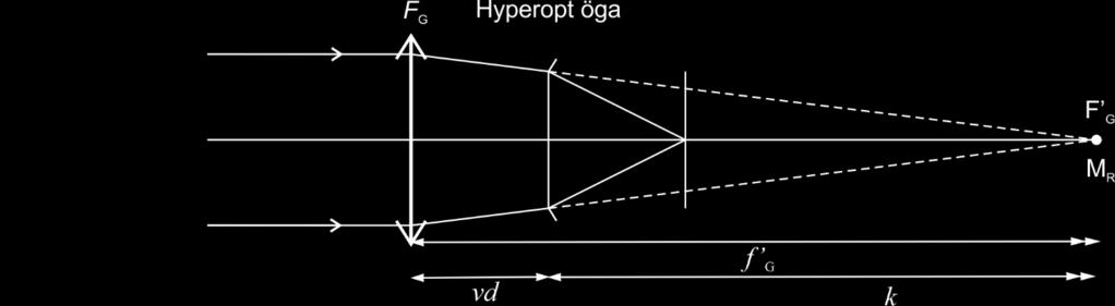 Optik 1 55 Från geometrin i figurerna ovan framgår att: Figur 11.2 Korrektionsprincipen hyperopt öga f G k vd (11.