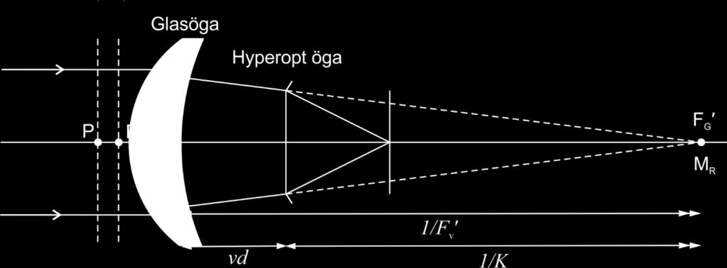 Huvudplanens läge vid olika linsformer: Figur 12.3 Huvudplan i tjocka linser Negativa linser är ofta så tunna på mitten att huvudplanen ligger tätt ihop, nära linsens vertex.