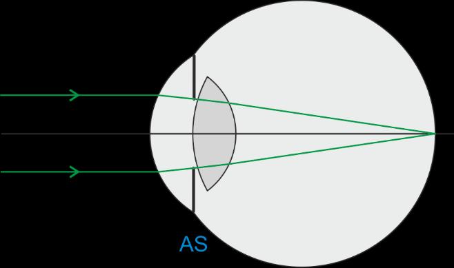 Optik 1 70 Bästa metoden för att hitta vilken öppning som är AS är att gissa och testa: (1) Gissa att första öppningen/linsen är AS (2) Dra en stråle från objektpunkten på axeln i kanten på första