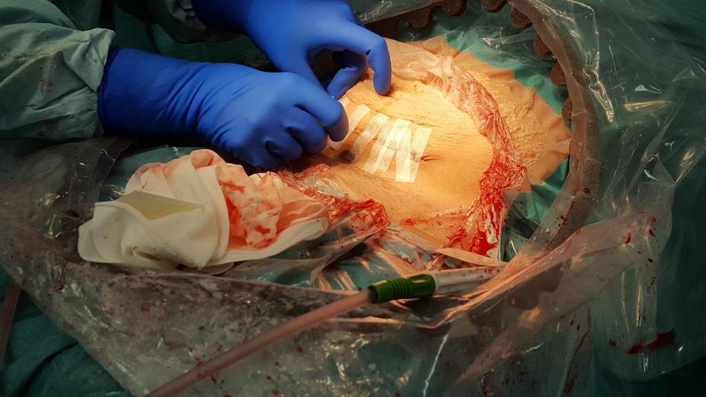 Operationssåret sys igen, tejpas med steristrip (se bild) och ovanpå sätts ett operationsförband.