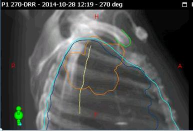 These images are used to design a treatment plan, with different field directions and to create the reference images called