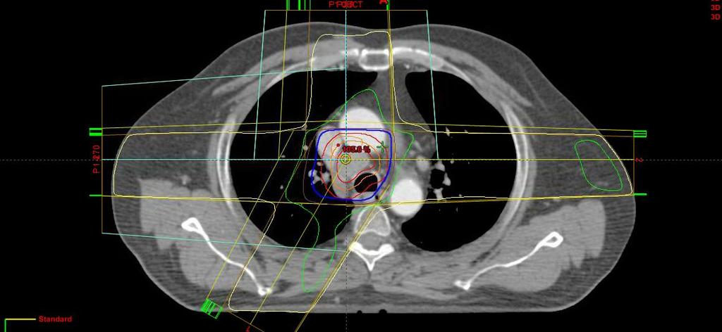 1.1.3 Contouring The visible tumor volume is outlined by an oncologist on the planning 3D CT-images, and is called Gross Tumor Volume (GTV).
