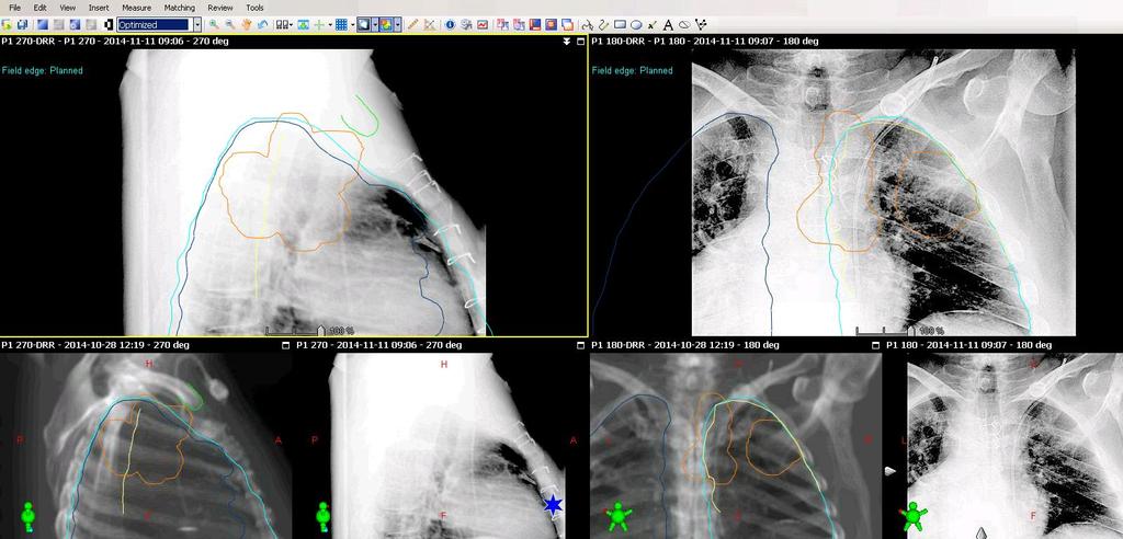 Picture 12: Shows two orthogonal Thorax images 2. Secondly a test patient was created on Eclipse treatment planning system and a CTimage set were performed on a chest anthropomorphic phantom. 3.