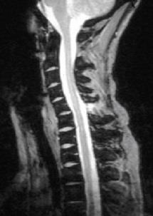 Bild 25 Spinalligamentskador: Totala rupturer kan diagnostiseras Större ligamentskador (totalrupturer) i andra delar av nacken kan diagnostiseras ganska enkelt.