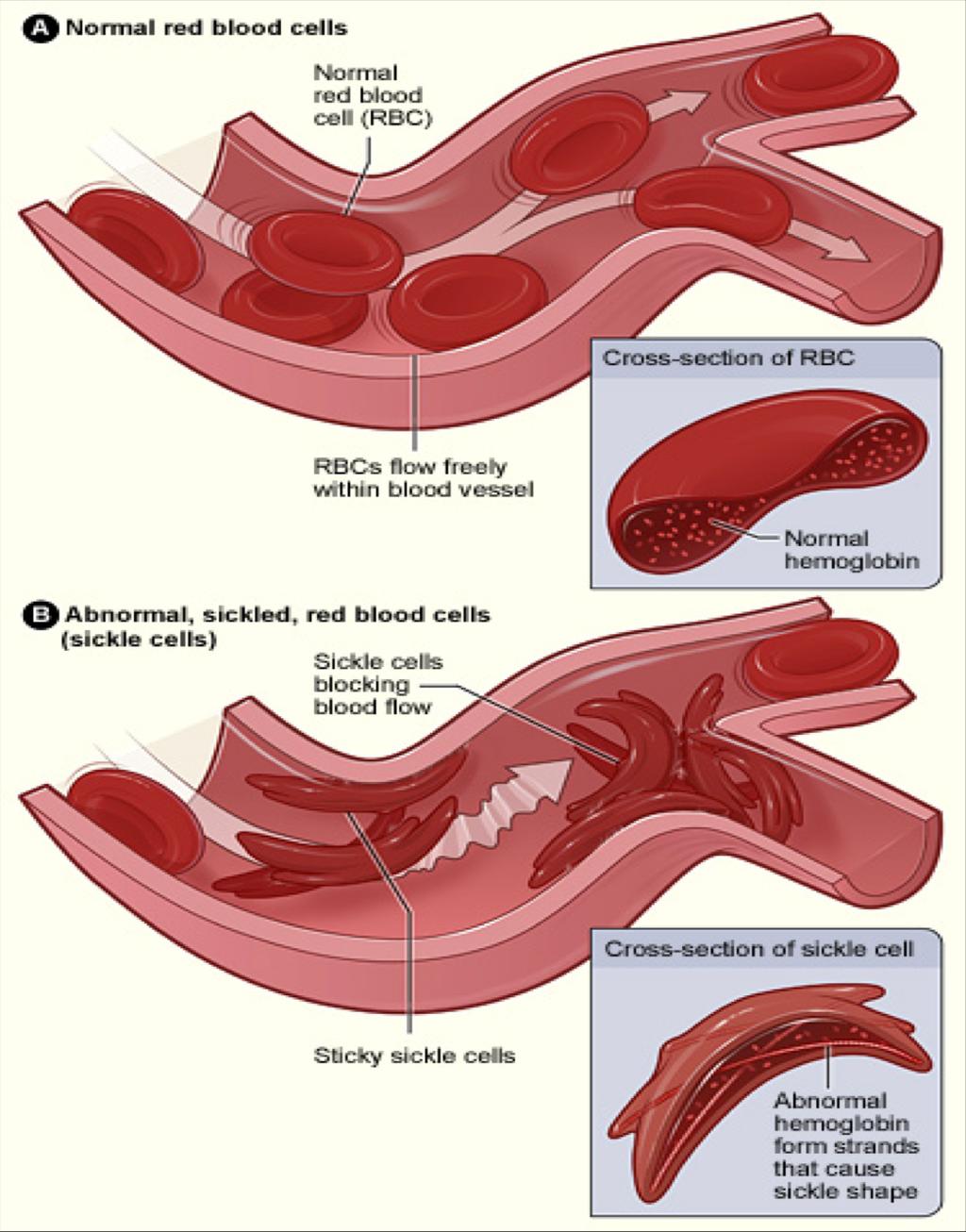 Sicklecellsanemi Erytrocyterna ser ut som skäror : Sjukdomen innebär att de röda blodkropparna (erytrocyterna) ser ut som skäror (eng. sickle) istället för att ha normal form.