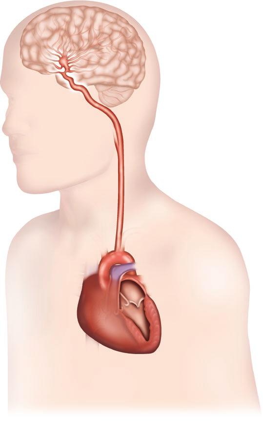 Du 4. Om blodproppen hamnar i ett kärl i hjärnan och täpper till det uppstår en infarkt. 5. Pradaxa förebygger blodkoagulationen och minskar därmed risken för hjärninfarkt.