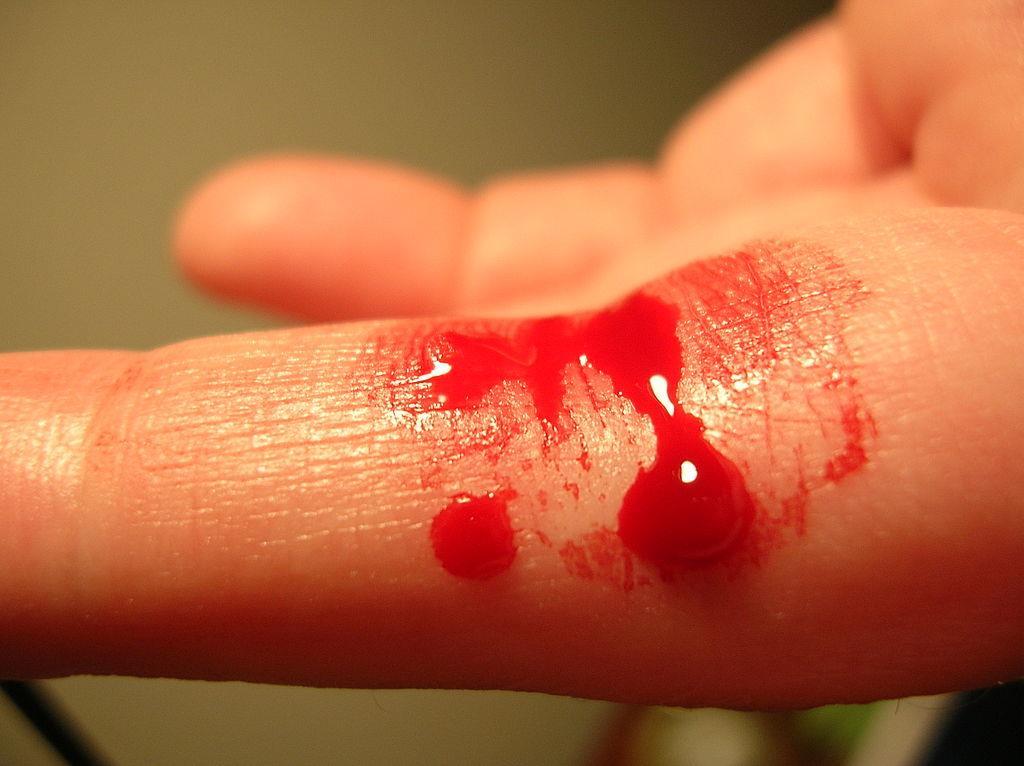 Blodburen smitta Överförs via blod, blodprodukter eller