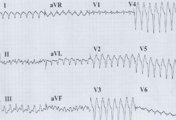 50. Tlka rytmen på följande EKG: a. Ventikelflimmer b.
