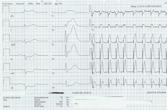51. Tlka följande EKG: a. Vänsterkammarbelastning (Ischemi) b. Subendkardiell Q-vågsinfarkt c. Transmural ST-höjningsinfarkt d. Andningskrrelerat högersidigt skänkelblck 52.