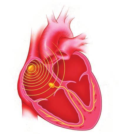 följer en elektrisk bana till kammaren. Detta skapar elektrisk stimulering som får hjärtmuskeln att dra sig samman.