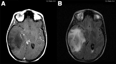 Diagnos Radiologi Lågmaligna gliom laddar inte kontrast på CT eller MRT. Tillkomst av kontrastuppladdning är i regel ett tecken på malignifiering (övergång till högre malignitetsgrad).